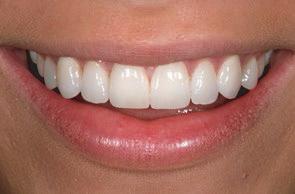 Adding porcelain to normal size teeth may make them appear too thick, too bulky too or too long. People with normal size teeth should consider other treatment options including traditional veneers.