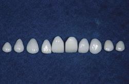 2 When bonded or adhered to natural teeth, porcelain veneers can create an amazing smile transformation.