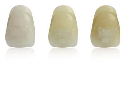 ClearVu and InVu Cosmetic Brackets The doctor-preferred design coupled with patient preferred aesthetics.