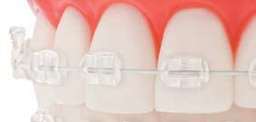 Pre-Coated Brackets featuring exact Pre-Applied Adhesive Pre-coated for convenient placement right out of the package Reduced risk of contamination Brackets set easily without sliding Minimal flash