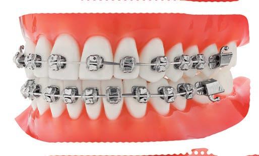 TIP-EDGE PLUS BRACKETS Designed for treatment efficiency and patient comfort. Tip-Edge PLUS brackets are part of a versatile system that utilizes light forces to move teeth naturally and efficiently.