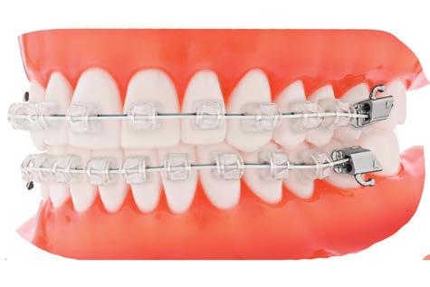Automatic rotational control Eliminates unwanted torque reaction to adjacent teeth Personalized Color-Matching Technology brand ceramic option available for enhanced aesthetics Available delivered in
