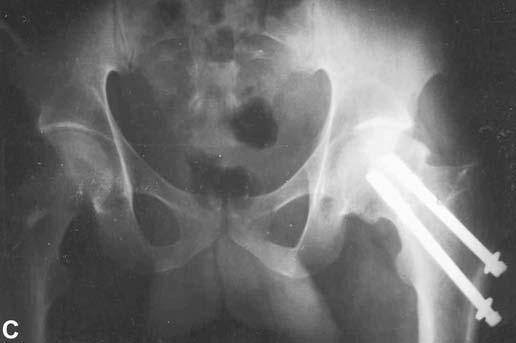 Bone scans performed within 2 weeks of operation following 306 non-neglected hip fractures have been shown to determine the healing course with an accuracy of 91% (into categories of uneventful