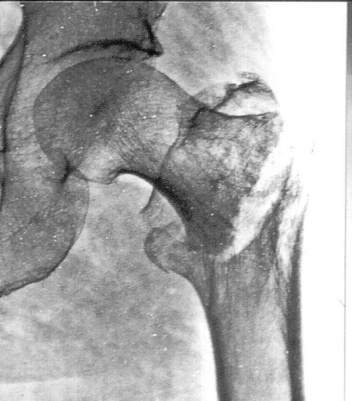 TROCHANTERIC FRACTURE: necrosis of the femoral head occurs only in 2 % blood loss is more expressed.
