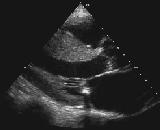 B-mode Ultrasound (B = brightness) Same as A-mode, but one dimensional graphical display with brightness corresponding to amplitude of reflected sound 2D real-time ultrasound Most modern ultrasound
