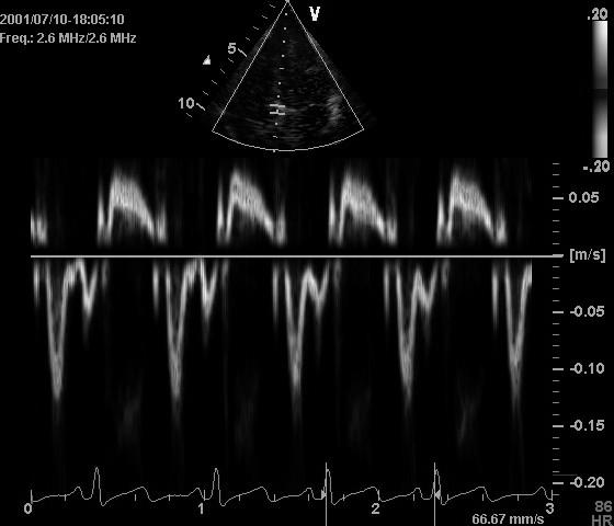 Doppler Ultrasound modes Pulse wave Doppler of