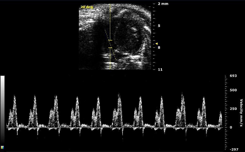 Apical Four Chamber - Tricuspid flow in PW Doppler Mode Figure 17 - PW