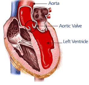 At base of aorta 2. Prevents return of blood to the left ventricle. V.