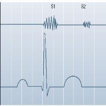 VIII. Heart Sounds A. Vibrations in heart tissues B. Due to blood rapidly changing velocity within the heart. C. Described as a "lub-dup" sound. 1.
