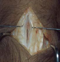 Patellar Tendinosis Anterior knee pain, non-acute