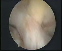 Arthroscopic Assessment ACL Injury Delay in