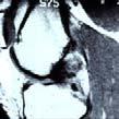 Posterior Cruciate Ligament Rupture PCL Rupture History Blow to proximal