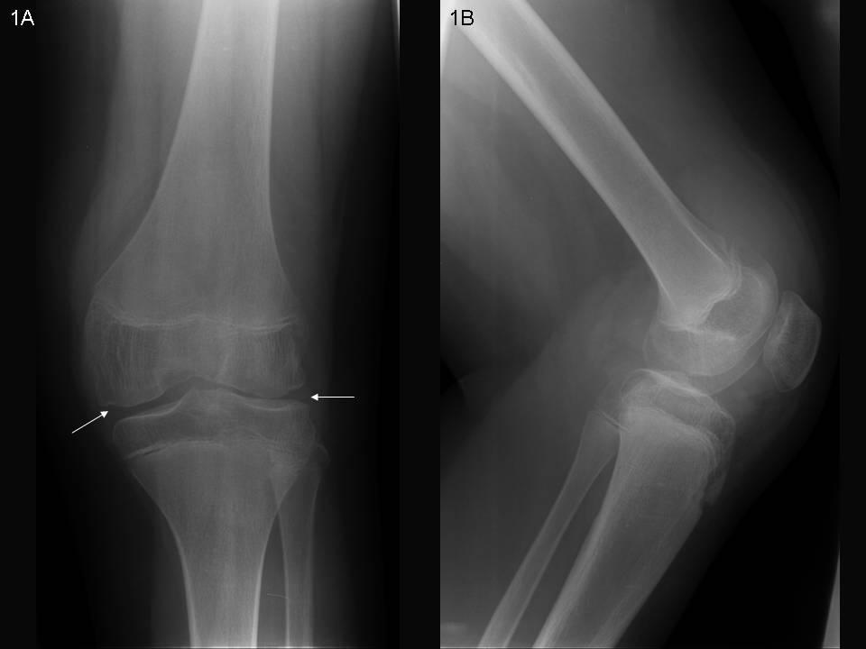 Figure 1: Conventional x-ray of the left knee (same examination