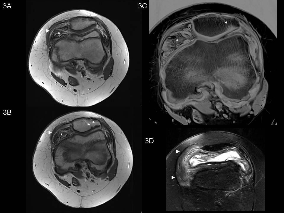 Figure 3A C: Enhanced T1w axial MRI. 3B: Inverted. 3D: Transversal T2w TSE with spectral fat saturation.