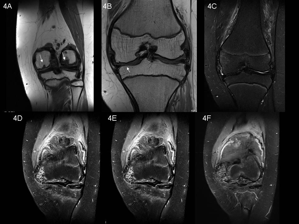 haematoma. Figure 4A: Coronal T1w SE showing erosion of the femur condyles. 4B: Thinning of tibial cartilage (arrow).