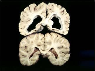 Huntington s Normal degenerated head of caudate Dystonia: involuntary movement in one or more of the limbs (proximal and not distal unlike Athetosis).