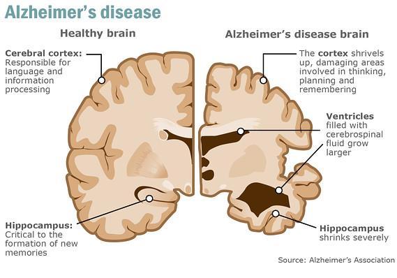 -Research focuses on Gene therapy. Alzheimer s Disease -Affect 10% of the > 65 y/o population 50% if > 85 y/o. -Not entirely hereditary.