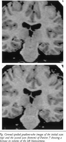R=0.6, p < 0.0007 F=15.4 Patients from first seizure clinic, TLE but not HS Correlation between hippocampal volume loss and 2 nd GTCS Briellmann et al.