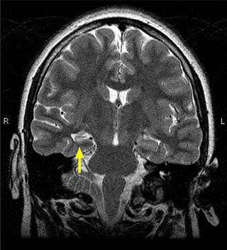 Mesial Temporal Lobe Sclerosis Typically associated with temporal lobe epilepsy Vulnerability of hippocampus to injury: TBI, anoxia Seizures Febrile