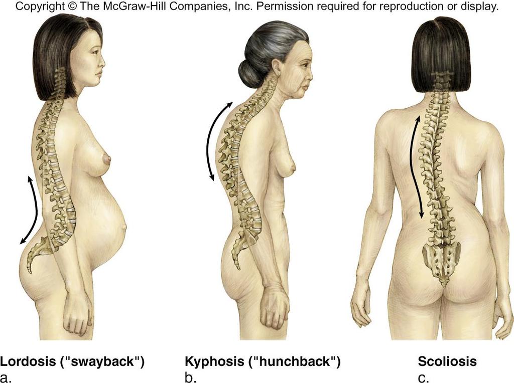 Abnormalities Lordosis exaggerated lumbar curvature Kyphosis increased roundness of the