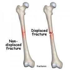 Bone Fractures (cont.) Closed (simple)- fractured bone(s) do not break through the skin.