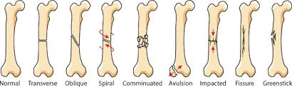 Bone Fractures (cont.) Transverse-when the broken piece of bone is at a right angle to the bone's axis. Oblique-when the break has a curved or sloped pattern.