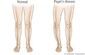 Diseases and Disorders of Bone (cont.