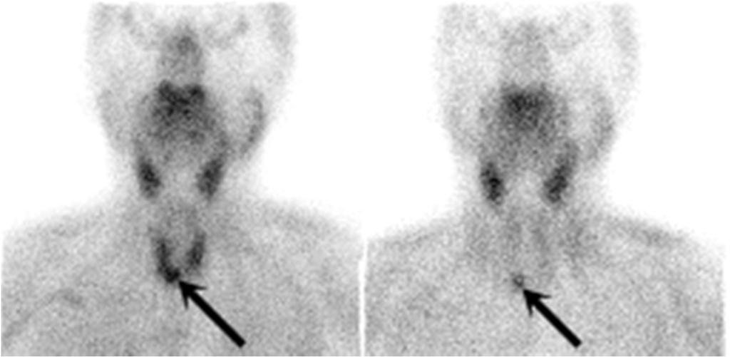 Parathyroid scintigraphy 20 Parathyroid