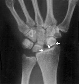 Complications If not repaired there tends to be proximal migration of the capitate between the scaphoid and lunate, associated with early and severe degenerative arthritis, ultimately resulting in a