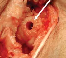 Osteochondral Autograft Transplantation Articular Defects in the Hand and Wrist Paul A.