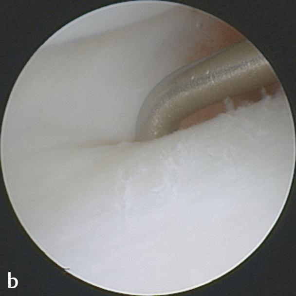 In the case of a break, a raised ripple effect is visible. b Arthroscopic view showing the probe positioned at the styloid recess.
