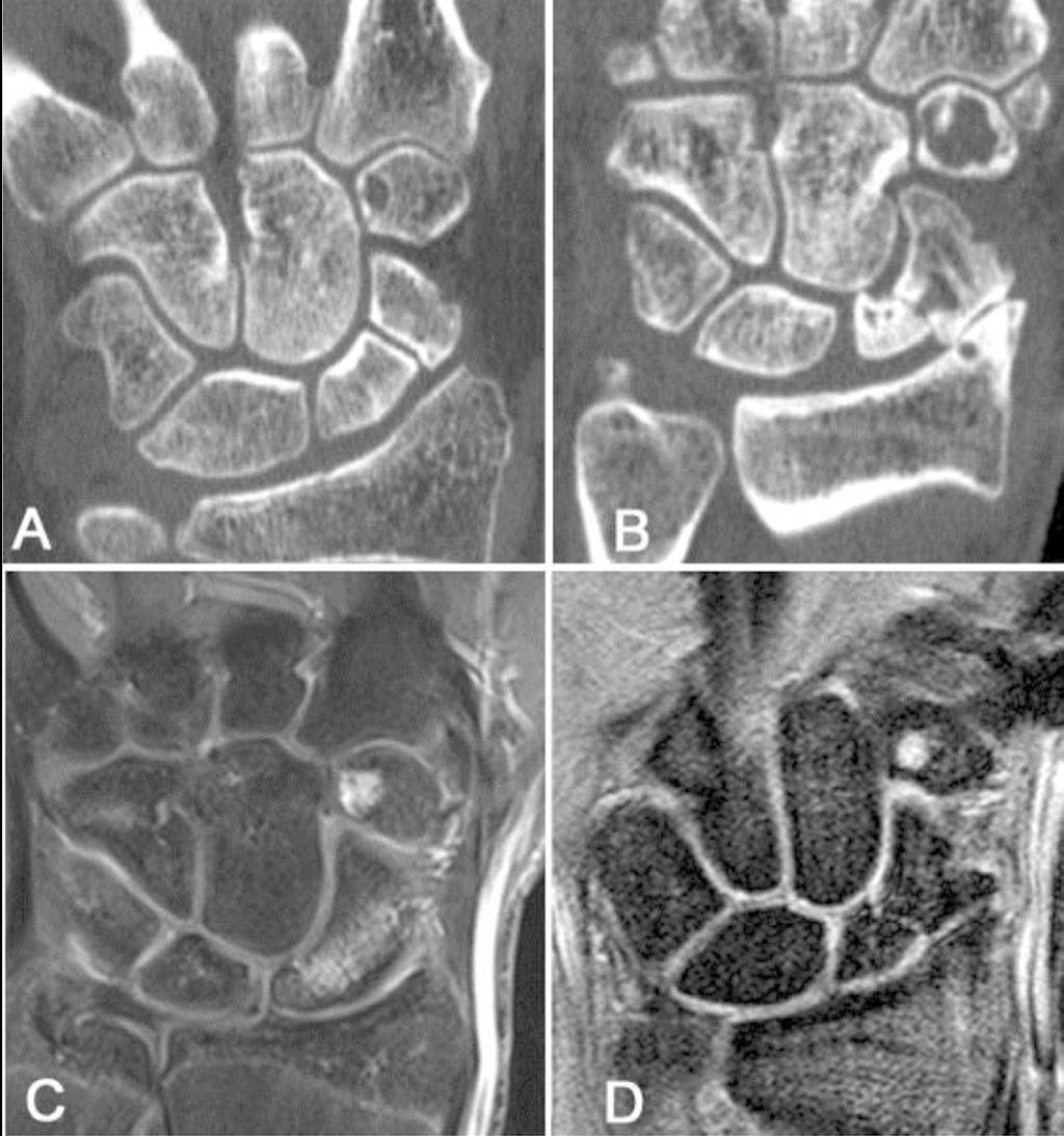 6 Figure 6.1 (A) and (B) Coronal CT slides of scaphoid nonunions of, respectively, 25 years and 21 years duration, showing trapezoid cysts, facing the capitate bone ulnarly.