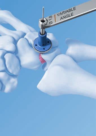 Innovative instrumentation Reamer with cannulation to