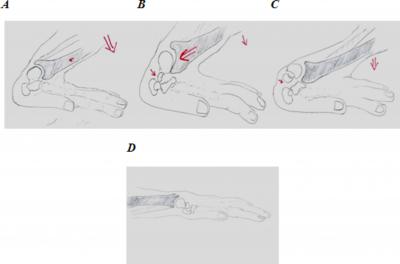 Figure 7 Figure 7 Mechanism of carpal fractures from falls on outstretched hand with wrist going into marked dorsiflexion. A, Wrist in marked dorsiflexion.