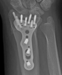 Radial Osteotomy Results Capitate Shortening Osteotomy Hanel et al» Atlas Hand Clin 4: 45-58 1999 Remarkable results 1 year