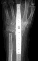 wrist poor bone stock previous surgical fusion if