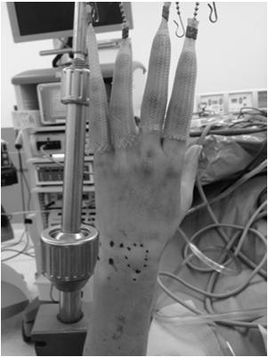 Pre-op Evaluation of patient Traction / Suspension Surgeon may identify anatomic abnormalities Difficult to differentiate b/w asx degenerative findings and pathologic findings wrist pain