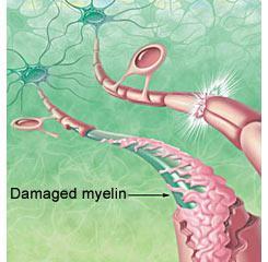 Multiple Sclerosis Multiple Sclerosis (MS) is the result of damage to the myelin sheath which protects the nerve fibres. The sheath becomes hardened (sclerosis) in many (multiple) places.