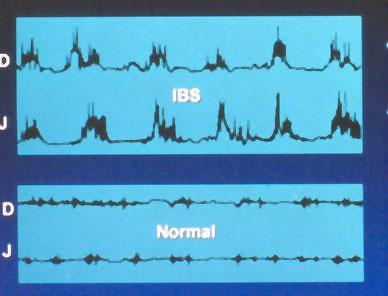 IBS - Abnormal motility Discrete Clustered Contractions (DCCs) Phase II of MMC More