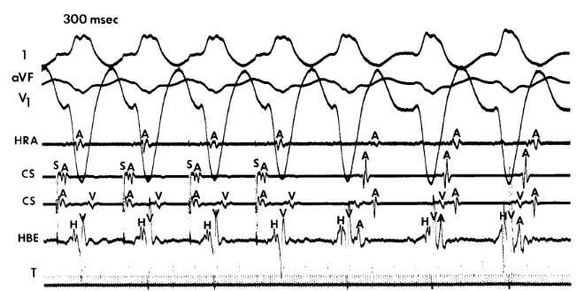 Intermediate HV interval during fully preexcited QRS HV= - 40 ms Josephson