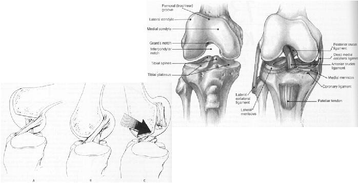 Anterior Cruciate Ligament History hyperextension injury feel/hear a pop knee effusion occurs within an