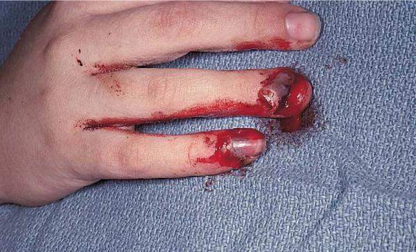Nailbed injuries Probably most common hand injury esp.
