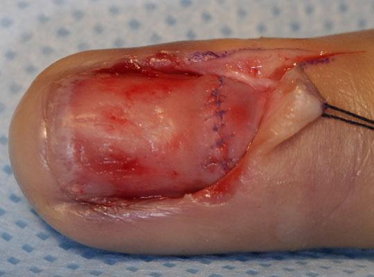 door Often assoc with underlying # May also be assoc with pulp injury If no nail