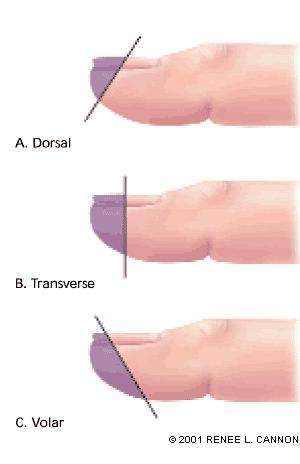 Amputations Fingertip injuries - may be suitable for composite grafting