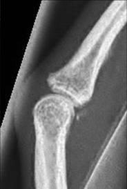 Tearing of volar plate +/- avulsion fracture