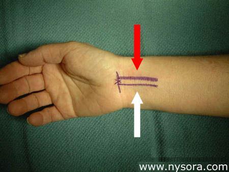 Median Nerve at the Wrist Common nerve to be injured at the wrist as very superficial Can also occur as part of carpal