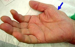 Median Nerve Lesions at the Wrist Loss of function of the LOAF muscles of the hand Specifically examine oppposition/thumb