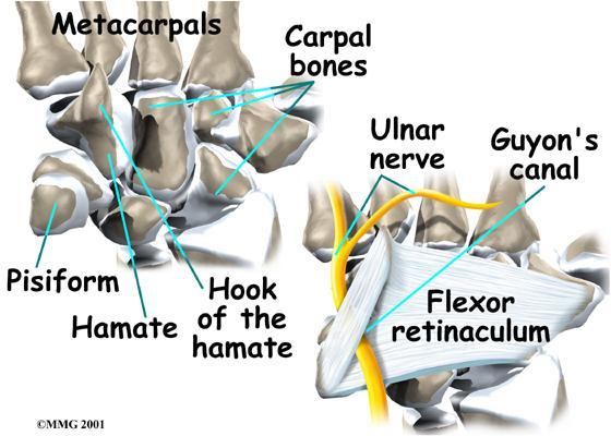 Guyon s Canal Syndrome Can be a chronic problem similar to carpal tunnel syndrome Can be acute, as in Hook of Hamate fractures If distal, only