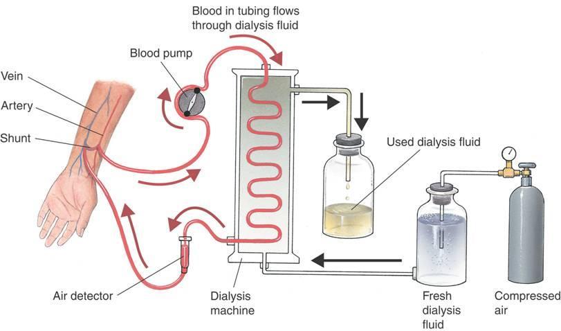Homeostasis by Machine Kidney Dialysis Vein Artery Blood pump Blood in tubing flows through dialysis