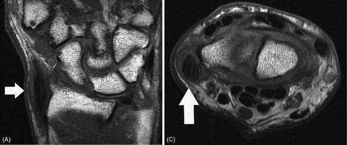 Internal Derangement De Quervain s Disease Tendonopathy and Tenovagitits of 1 st Extensor Compartment affecting APL & EPB at level of styloid process in zone VII